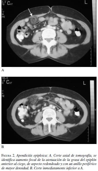 Apendicitis Epiploica, tomografía y Corte inmediatamente inferior Apendicitis Epiploica, tomografía y Corte inmediatamente inferior