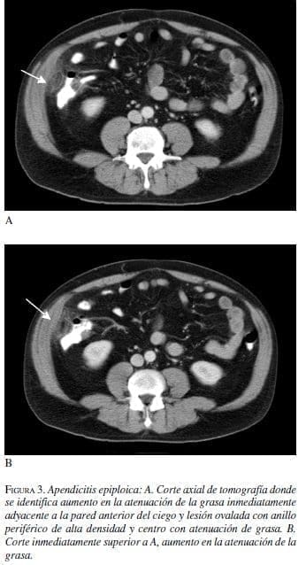 Apendicitis Epiploica, tomografía y Corte inmediatamente superior Apendicitis Epiploica, tomografía y Corte inmediatamente superior