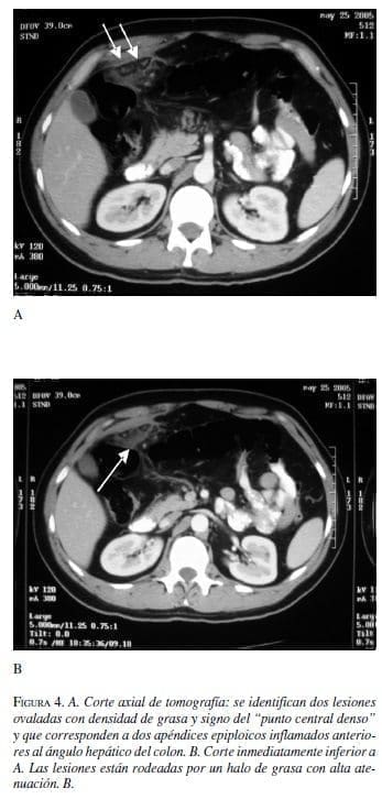 Corte axial de tomografía Corte axial de tomografía
