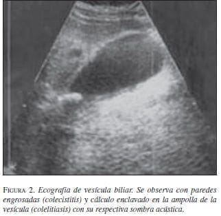 Ecografia de Vesícula Biliar