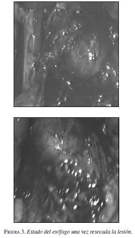 Estado del Esófago una vez resecada la lesión