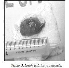 Lesión Quística ya resecada