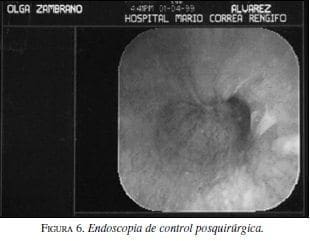 Endoscopia de control posquirúrgica