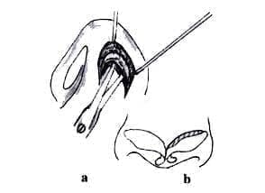 Técnica Quirúrgica Técnica Quirúrgica