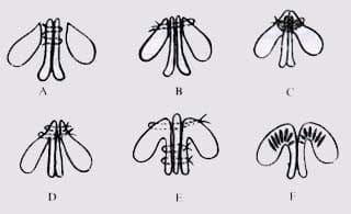 Modificaciones Quirúrgicas Modificaciones Quirúrgicas