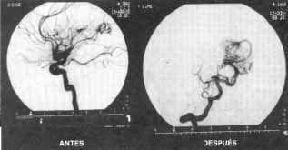 Embolización Selectiva de una Malformación