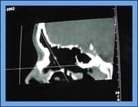 Cintura ostium y parte inferior receso frontal