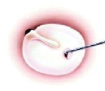 Perforación con un gancho o con láser