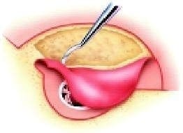 Sutura timpanomastoidea y timpanoescamosa