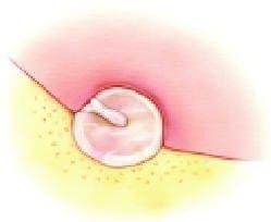 Remoción de la piel del CAE