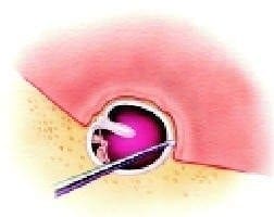 Colocación de la fascia