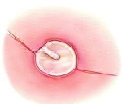 Reposición de la piel