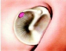 Perforaciones marginales