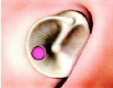 Perforaciones marginales