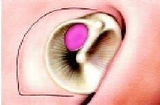 Extracción del injerto de fascia