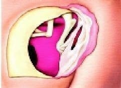 Extracción del injerto de fascia