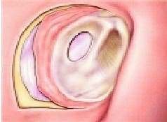 Extracción del injerto de fascia