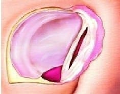 Cuadrantes de la membrana timpánica