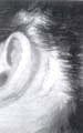 Cicatriz hipertrófica retroauricular
