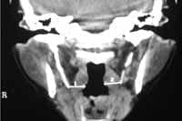 Proceso estiloideo y la luz orofaríngea