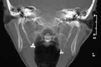 Pseudoarticulado