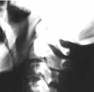 Proceso estiloideo elongado