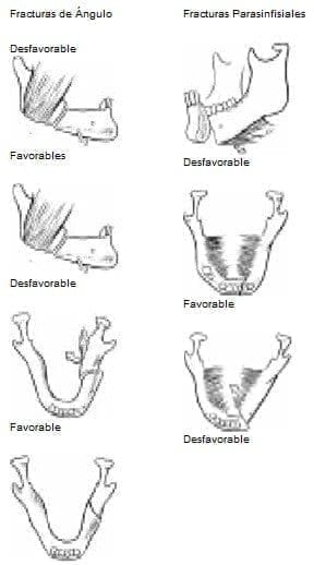Fracturas de Ángulo