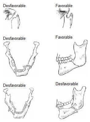 Fracturas Condilares