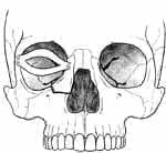 Fractura naso orbito etmoidal tipo I