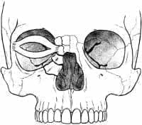Fractura nasa órbito etmoidal
