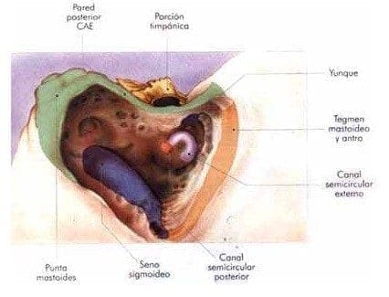 Cavidad de mastoidectomía