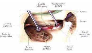 Timpanotomía posterior