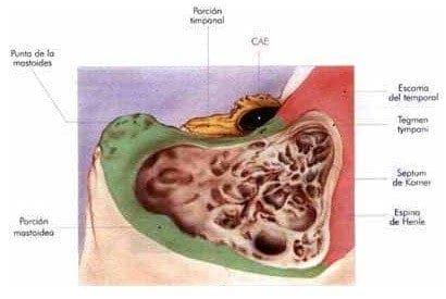 Profundización de la cavidad