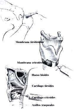 Bloqueo traslaríngeo