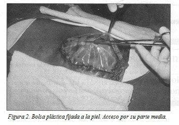 Bolsa Plástica fijada a la piel Bolsa Plástica fijada a la pie