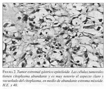 Tumor Estromal Gástrico Epitelioide Tumor Estromal Gástrico Epitelioide