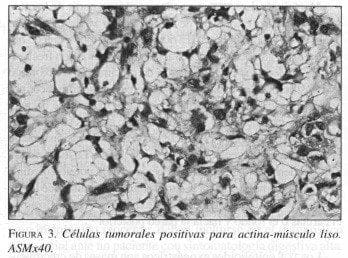 Células Tumorales Positivas para Actina-músculo liso Células Tumorales Positivas para Actina-músculo liso