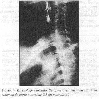 Rx Esófago Baritado