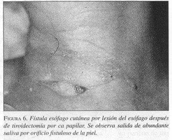 Fístula Esófago Cutánea por Lesión del Esófago  Fístula Esófago Cutánea por Lesión del Esófago