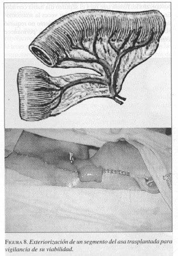 Exteriorización de un Segmento del Asa Trasplantada Exteriorización de un Segmento del Asa Trasplantada