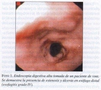 Endoscopia Digestiva alta tomada de un paciente de VIME