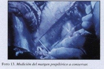 Medición del margen prepilórico a conservar