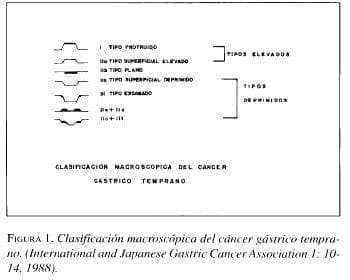 Clasificación Macroscópica del Cáncer Gástrico