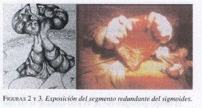 Exposición del Segmento redundante del Sigmoides Exposición del Segmento redundante del Sigmoides