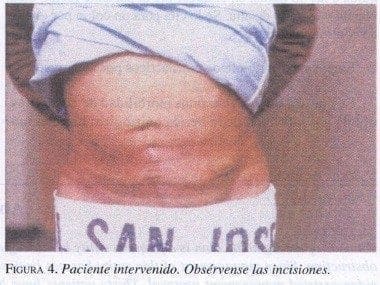 Paciente intervenido. Obsérvense las incisiones Paciente intervenido. Obsérvense las incisiones