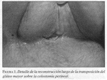 Transposición del Glúteo Mayor