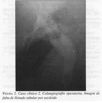 Colangiografía Operatoria