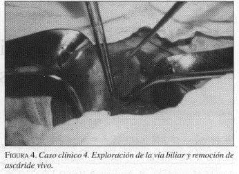 Exploración de la vía Biliar y remoción de Ascáride vivo Exploración de la vía Biliar y remoción de Ascáride vivo