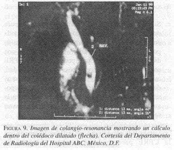 Imagen de Colangio-resonancia mostrando un Cálculo Imagen de Colangio-resonancia mostrando un Cálculo