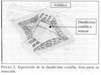 Exposición de la Duodécima costilla, lista para su resección Exposición de la Duodécima costilla, lista para su resección